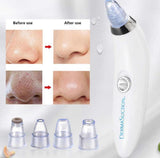 Dead Skin Removal Derma Suction Facial Cleanser - 1 Pack
